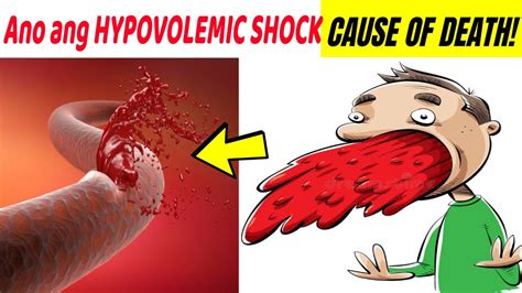 kadalasang sanhi ng pagsusuka ng dugo|Gastroenteritis .
